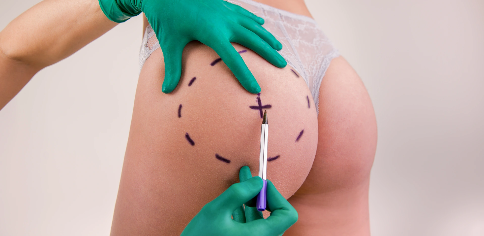 Gluteoplastia o cirugía plástica de glúteos