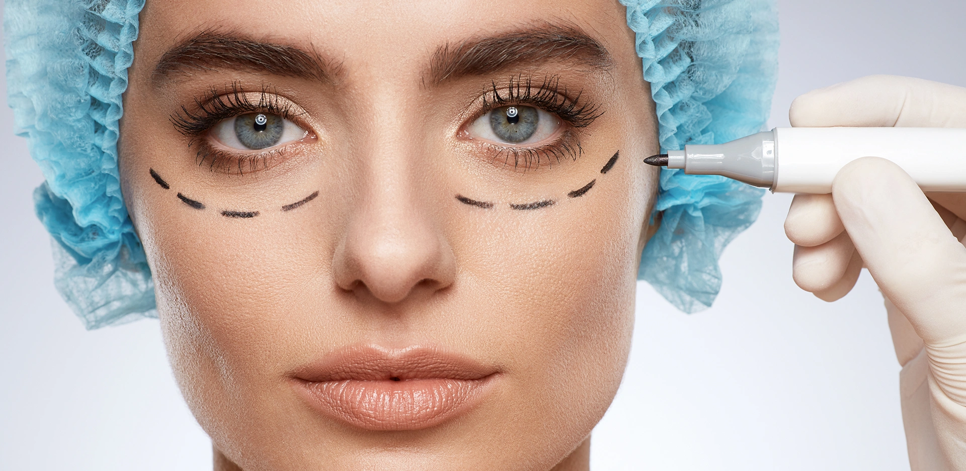 Blefaroplastia