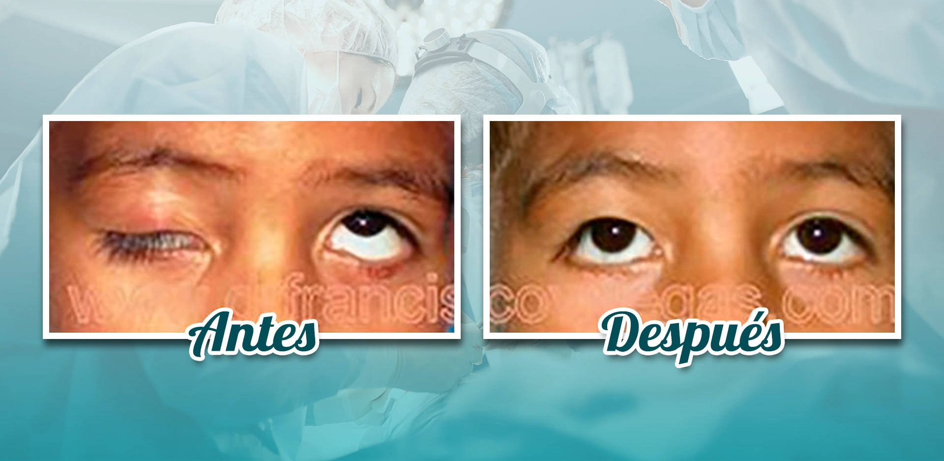 Cirugía de Ptosis o Párpado Caido